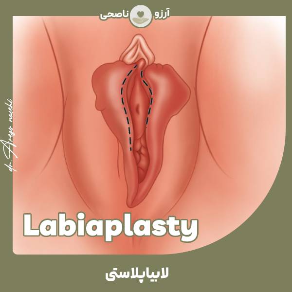 لابیاپلاستی - دکتر آرزو ناصحی