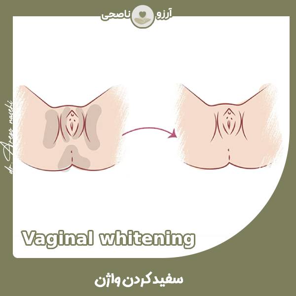 سفید کردن واژن - دکتر آرزو ناصحی