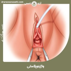 واژینوپلاستی - دکتر آرزو ناصحی