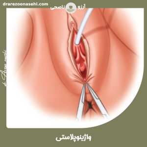 واژینوپلاستی - دکتر آرزو ناصحی