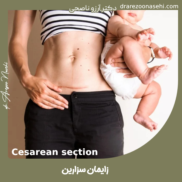 زایمان سزارین - دکتر آرزو ناصحی