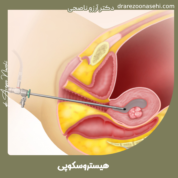 هیستروسکوپی - دکتر آرزو ناصحی