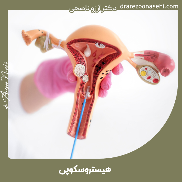 هیستروسکوپی - دکتر آرزو ناصحی