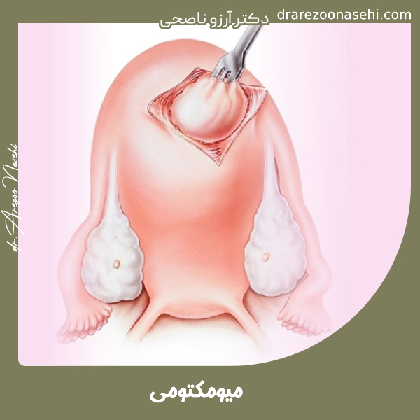 میومکتومی - دکتر آرزوو ناصحی