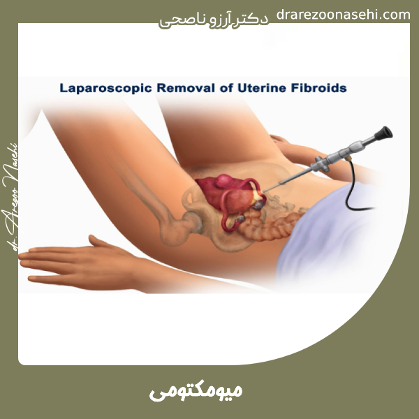 میومکتومی - دکتر آرزوو ناصحی
