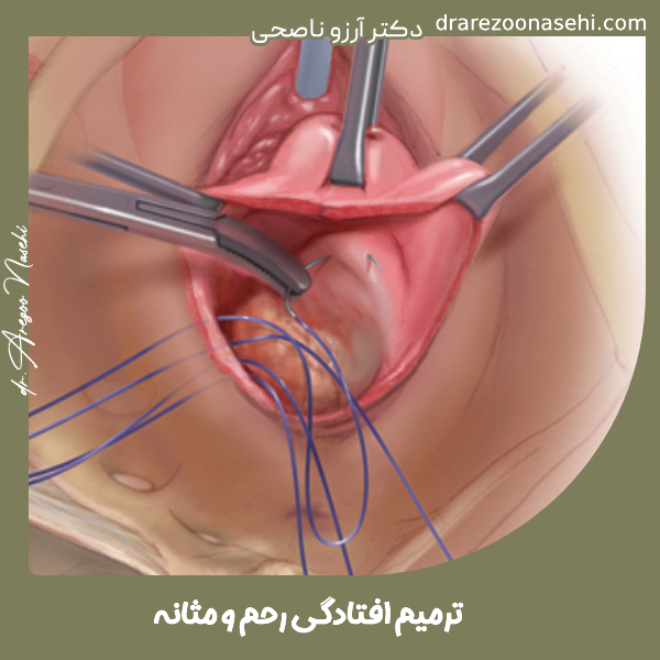 ترمیم افتادگی رحم و مثانه - دکتر آرزو ناصحی
