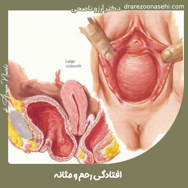 افتادگی رحم و مثانه - دکتر آرزو ناصحی