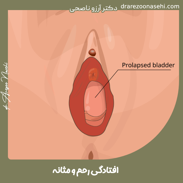 افتادگی رحم و مثانه - دکتر آرزو ناصحی