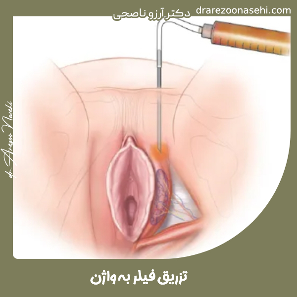 تزریق فیلر به واژن - دکتر آرزو ناصحی