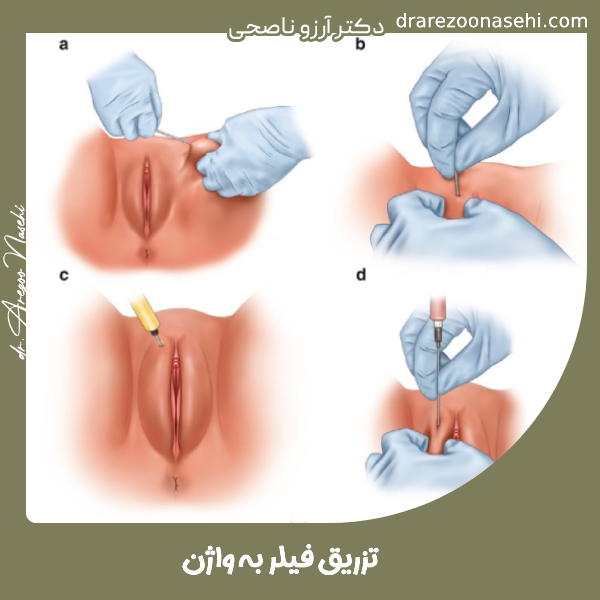 تزریق فیلر به واژن - دکتر آرزو ناصحی