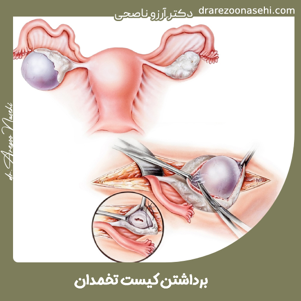 برداشتن کیست تخمدان - دکتر آرزو ناصحی