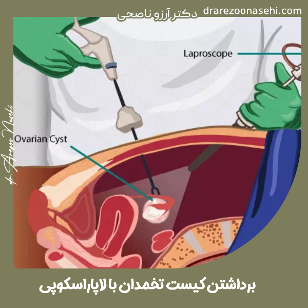 برداشتن کیست تخمدان - دکتر آرزو ناصحی