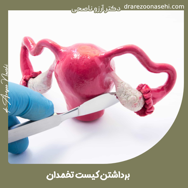 برداشتن کیست تخمدان - دکتر آرزو ناصحی