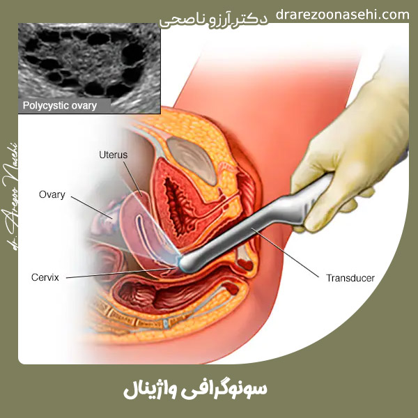 سونوگرافی واژینال - دکتر آرزو ناصحی